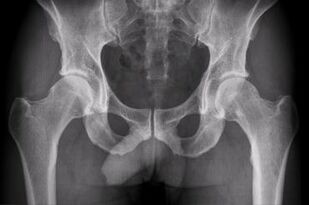 options for diagnosing arthrosis of the hip joint