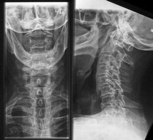 X-ray of the cervical spine - a method for diagnosing osteochondrosis