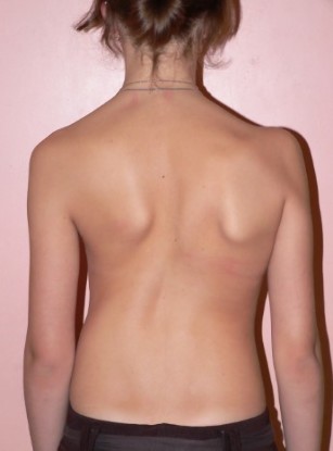 Scoliosis of 2 degrees