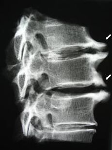 Osteophytes of the cervical spine cause neck pain