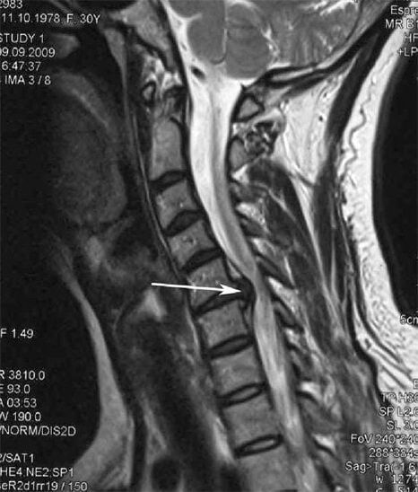 Spinal Cord Damage Triggers Neck Pain