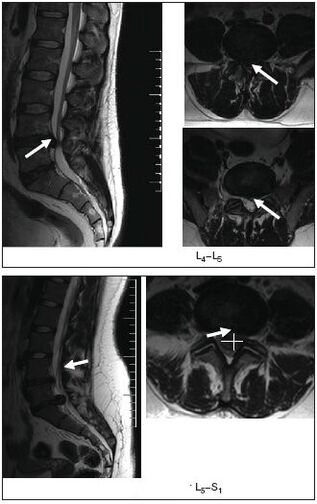 MRI scan of herniated disc of the spine