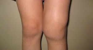 Deformity of the knee