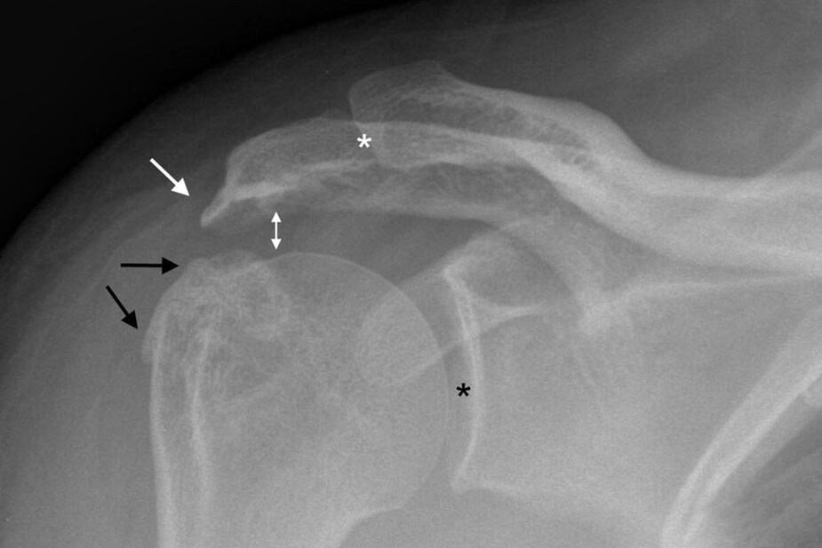 arthrosis of the shoulder joint on x-ray