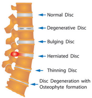 various damaged disc of the spine